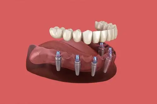  Bio3 Implants (کپی)